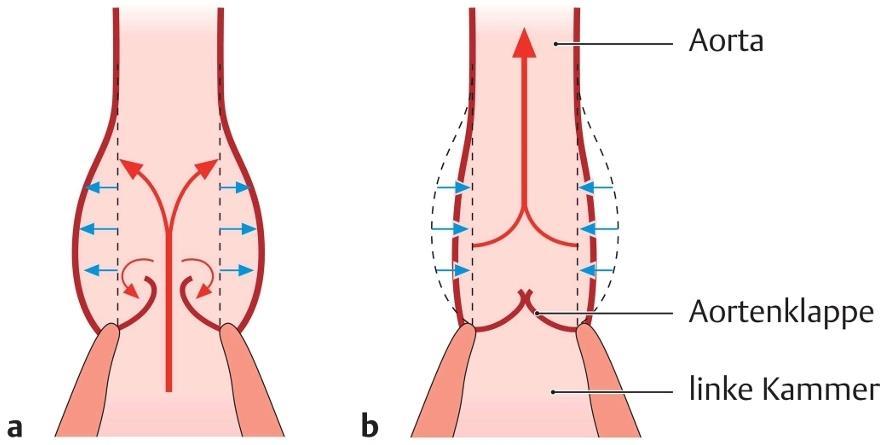 Windkesselfunktionder Aorta (a) Die elastische Wand der Aorta wird durch das Blutvolumen gedehnt (blaue Pfeile), das während der Austreibungsphase (Systole) vom linken Ventrikel ausgeworfen wird